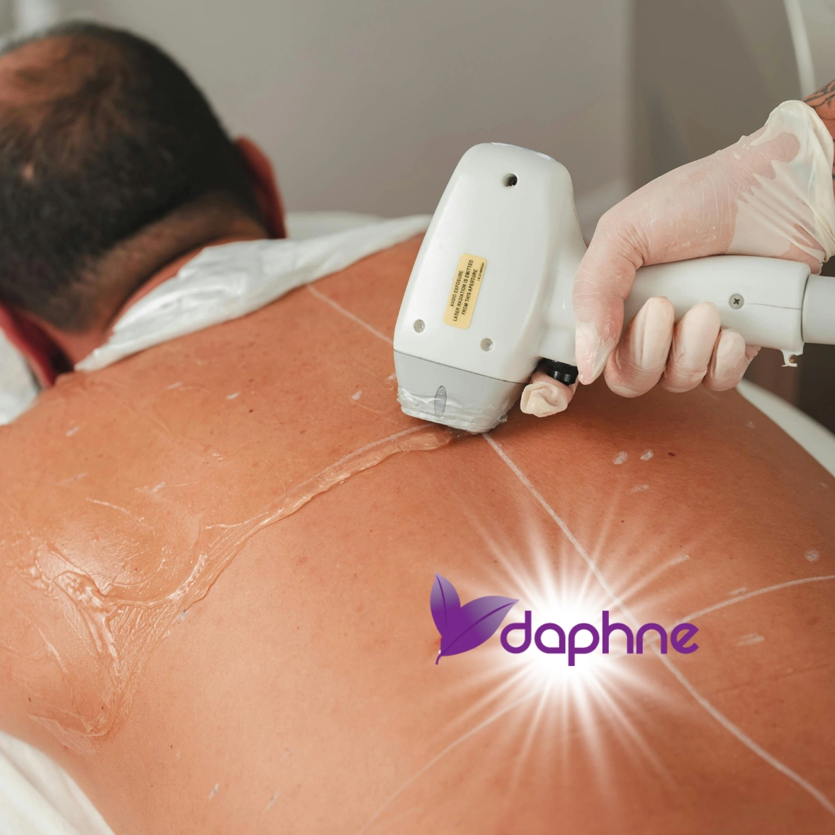 Buttock crease laser hair removal planning for the buttocks, tailbone line and outer perianal area