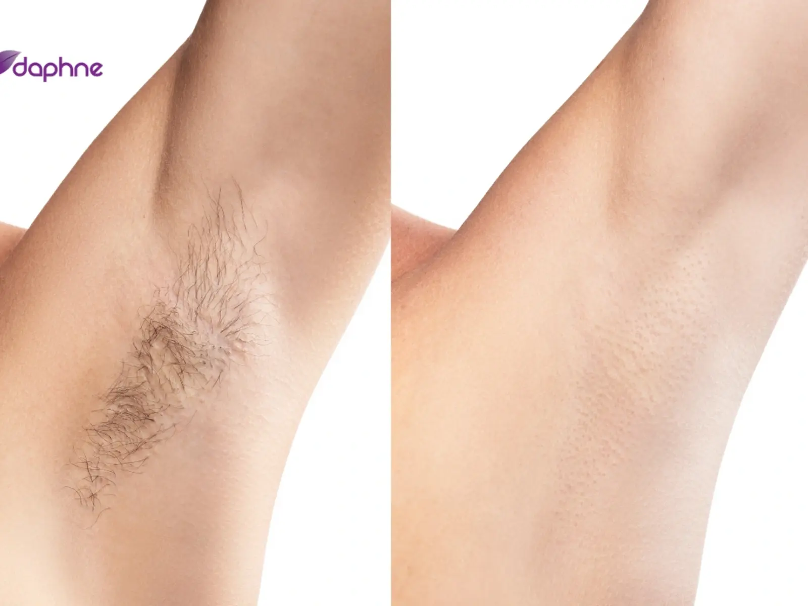 Underarm laser hair removal treatment planning