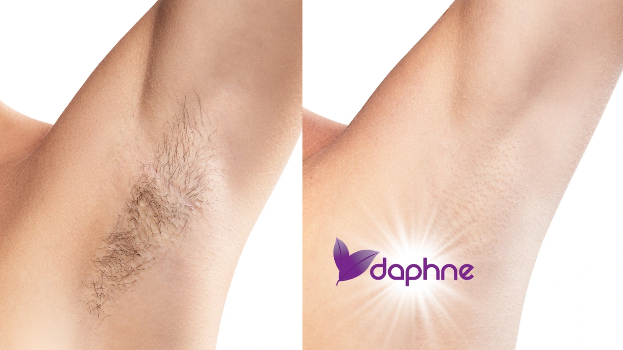 Does Laser Hair Removal Remove Hair Completely? Does laser really remove hair permanently?